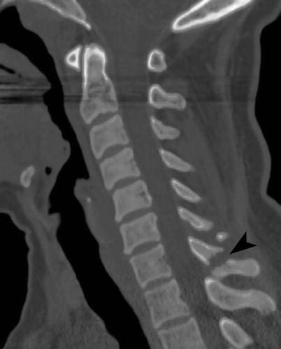 Clay-shoveler's-fracture - El Paso Chiropractor