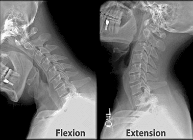 Flexion-Extension-Rayos-X - El Paso Chiropractor