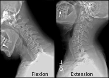 Flexion and Extension on X Ray - El Paso Chiropractor