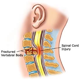 Fratture e danni al cavo spinale - El Paso Chiropratico