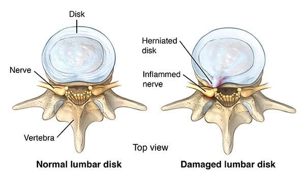 Top view of a healthy lumbar vertebra and unhealthy lumbar vertebra with a herniated disk and inflammed nerve - El Paso Chiropractor