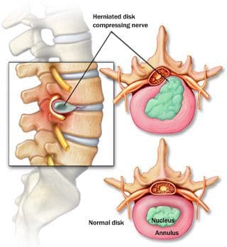 Diagrama detallado del disco herniado - El Paso Chiropractor