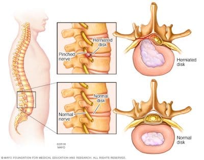 Herniated Disc Diagram - El Paso Chiropractor