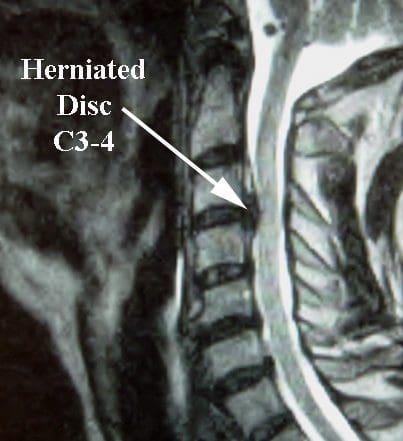 Herniated Disc MRI - El Paso Chiropractor
