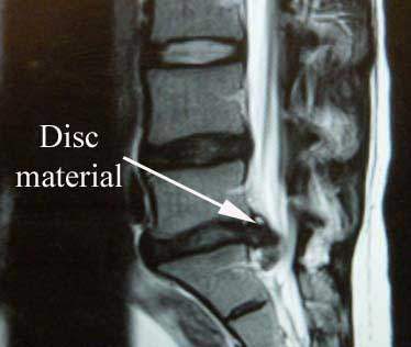 Herniated Disc MRI2 - El Paso Chiropractor