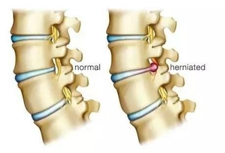 Lateral Herniated Disc - El Paso Chiropractor