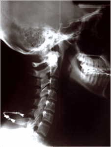 Lateral Neck X Ray - El Paso Chiropractor