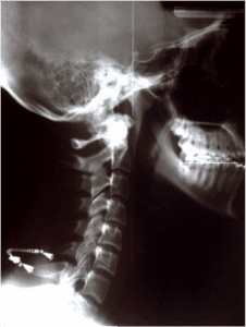 Cuello Lateral X Ray - El Paso Chiropractor