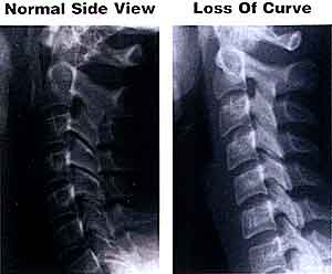 Loss of Cervical Curvature X Ray - El Paso Chiropractor