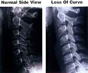 Hilangnya Cervical Curvature X Ray - Chiropractor El Paso