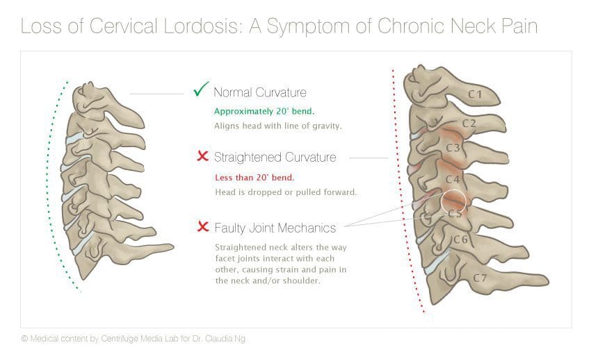 Loss of Cervical Lordosis Diagram - El Paso Chiropractor