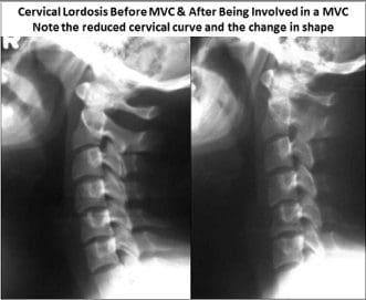 Loss of Cervical Lordosis - El Paso Chiropractor