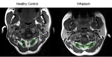 MRI Whiplash - El Paso Chiropractor
