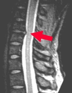 MRI of Cervical Herniated Disc - El Paso Chiropractor