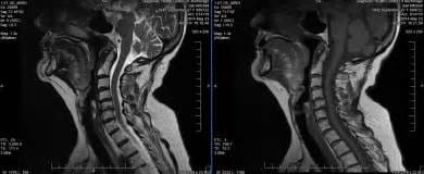 Neck Damage in MRI - El Paso Chiropractor