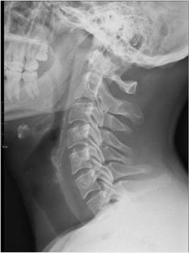 Normal Cervical Curve 1 - El Paso Chiropractor