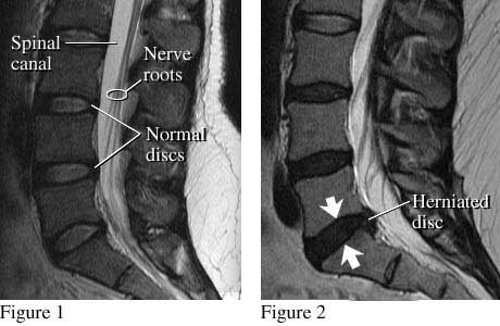 Normal and Herniated Disc Figures - El Paso Chiropractor