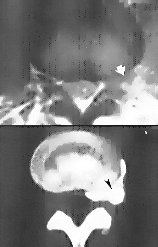 Evidenza radiografica di dischi erniati - Chiropratico El Paso