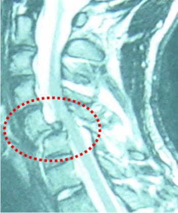 Lesión de la Médula Espinal - El Paso Chiropractor