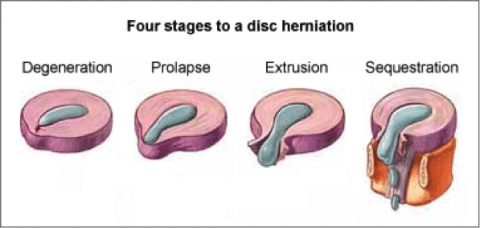 Stages of Disc Herniation - El Paso Chiropractor