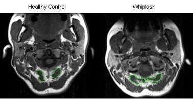 Whiplash CT Scan