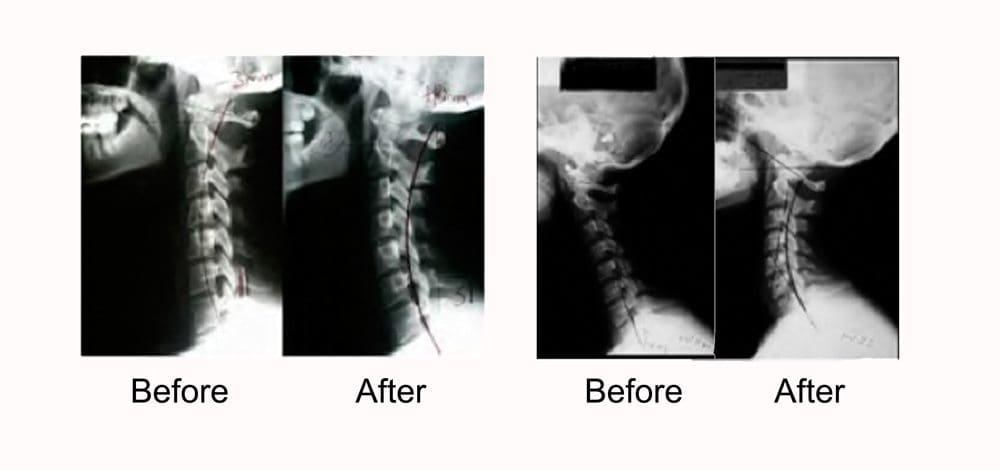 Whiplash Improvement X-Rays - El Paso Chiropractor