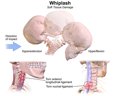 Whiplash Injury Diagram - El Paso Chiropractor