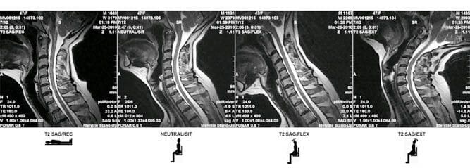 Whiplash Injury MRI - El Paso Chiropractor
