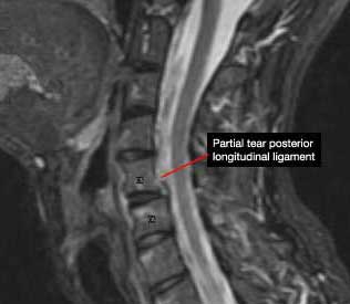Whiplash Injury on MRI - El Paso Chiropractor