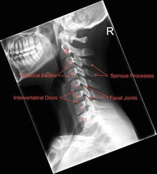 Whiplash Injury on X Rays - El Paso Chiropractor