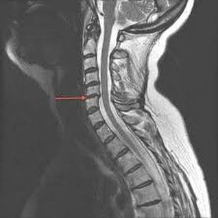 Whiplash on MRI Scan - El Paso Chiropractor