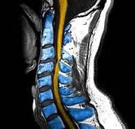 Whiplash_MRI_in_color - El Paso Chiropractor