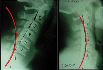 cervical lordosis and whiplash - el paso chiropractor