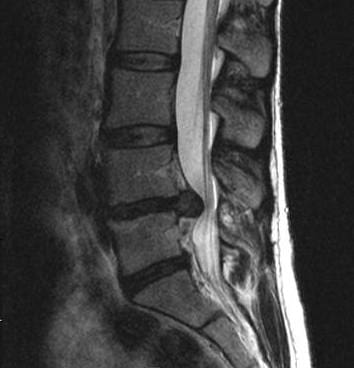 herniated-disc-large - El Paso Chiropractor