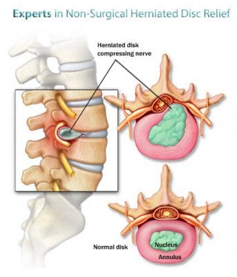 herniated-disc-treatment - El Paso Chiropractor