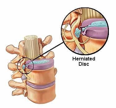 herniated disc - El Paso Chiropractor