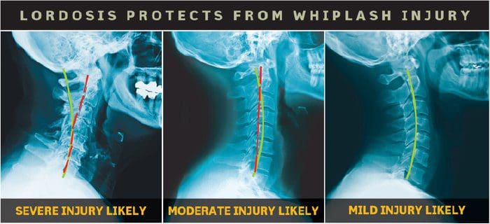 La lordosis protege contra el latigazo - El Paso Chiropractor