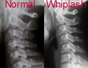normal and whiplash - El Paso Chiropractor