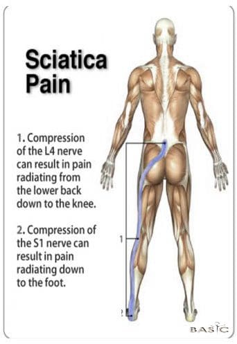 sciatica-pain-pic-pranic-healing2.jpg