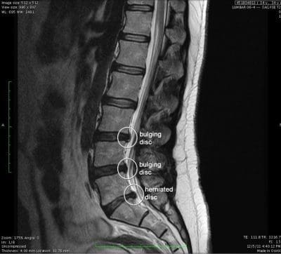 Bulging and Herniated Discs MRI