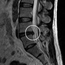 Circled Herniated Disc MRI