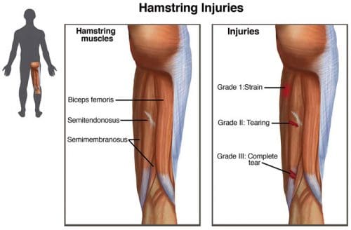 Hamstring injuries e