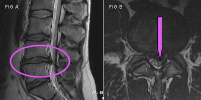 Herniated Disc More MRIs