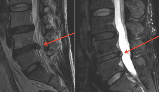 Herniated Disc More MRIs