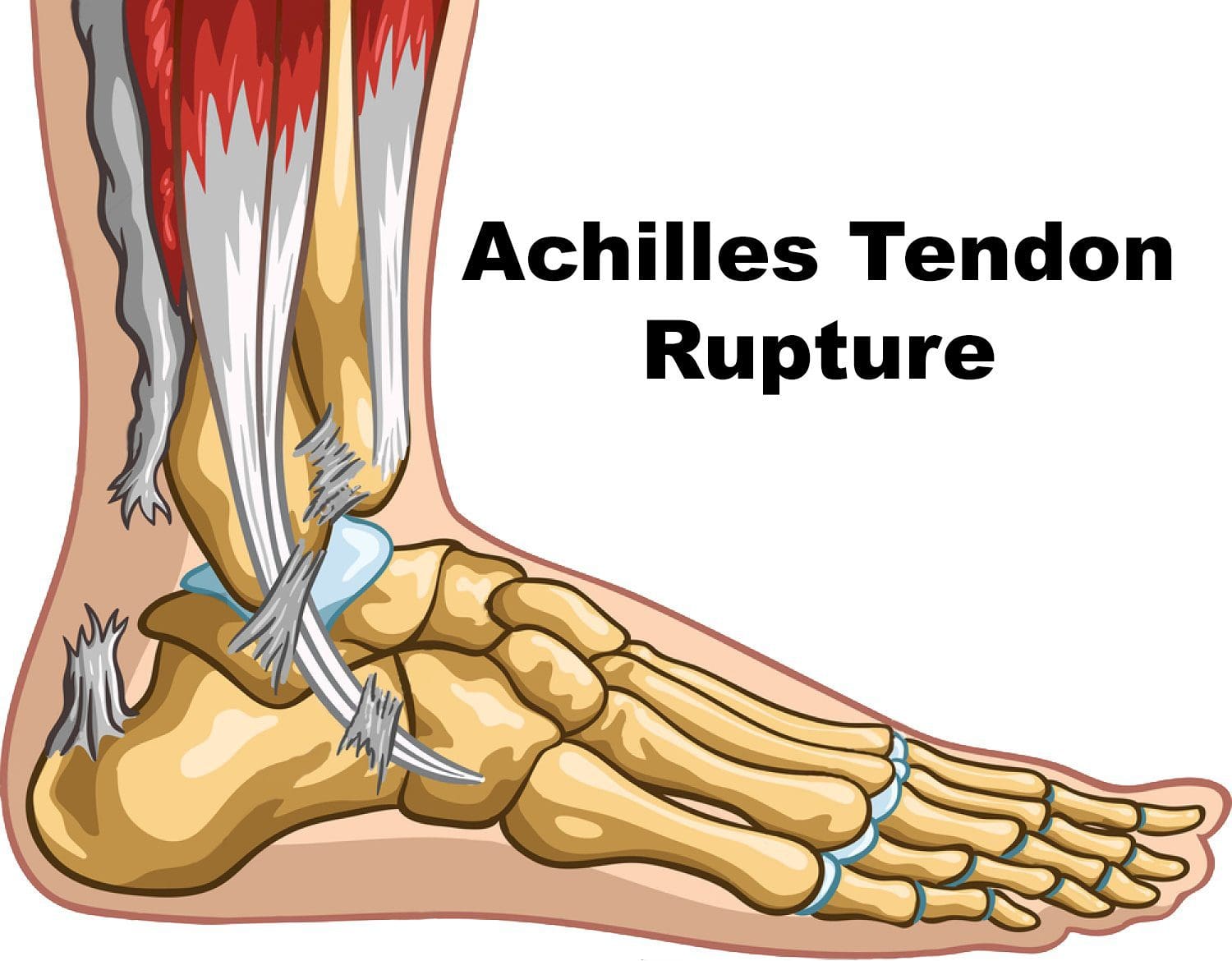 11860 Vista Del Sol, Ste. 128 Achilles Tendon Rupture, Likely Caused by Calf Injury