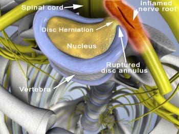 herniated disc e