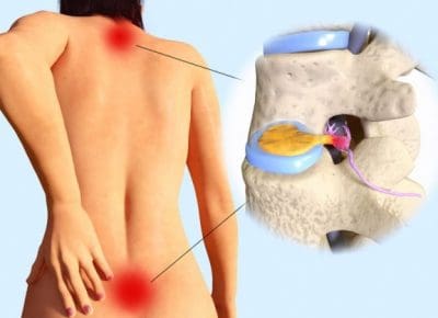 herniated_disc_neck_lowback48510818_M_edited
