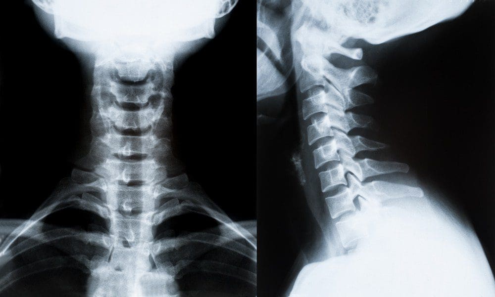 Image of X-rays demonstrating loss of cervical lordosis as a possible cause for migraine.