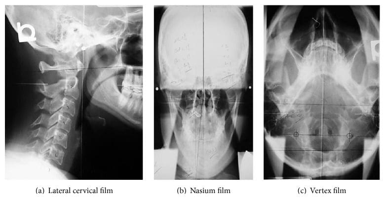 4 NUCCA Radiograph Series