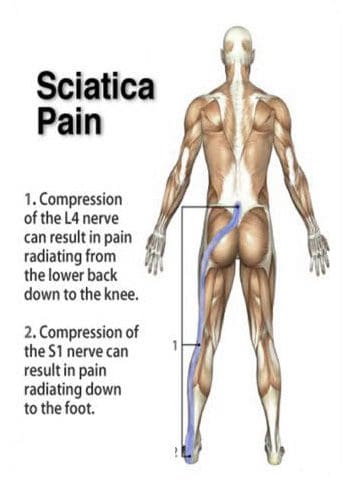 sciatica pain treatment
